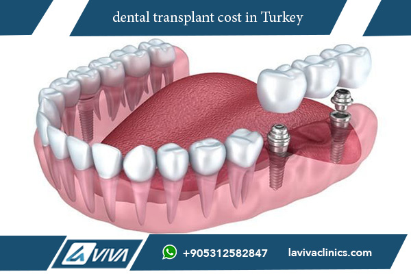 dental transplant cost