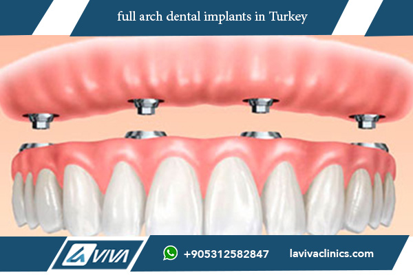 full arch dental implants