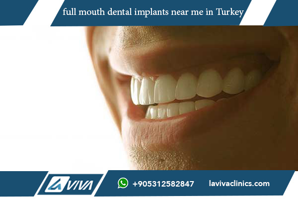 10 Key Benefits of Full Mouth Dental Implants Near Me: Positive Feelings and Perfect Smiles