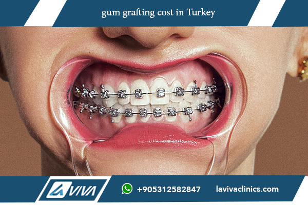 gum grafting cost