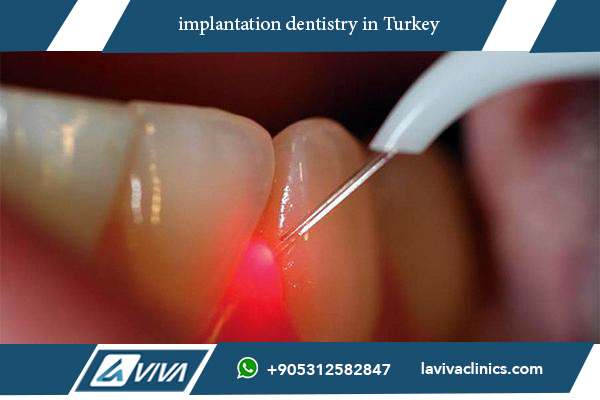 implantation dentistry