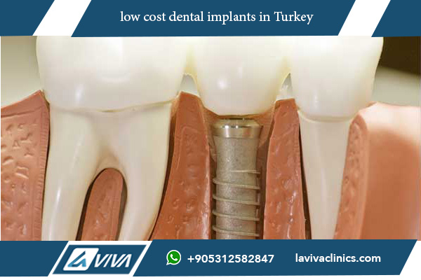 low cost dental implants