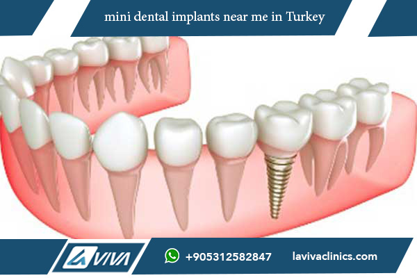 mini dental implants near me