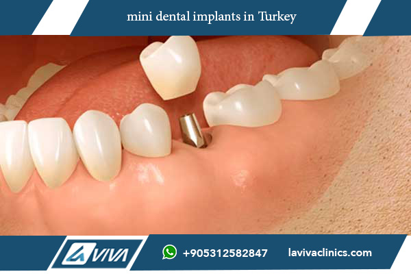 mini dental implants