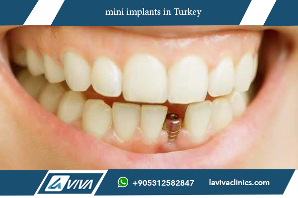 mini implants