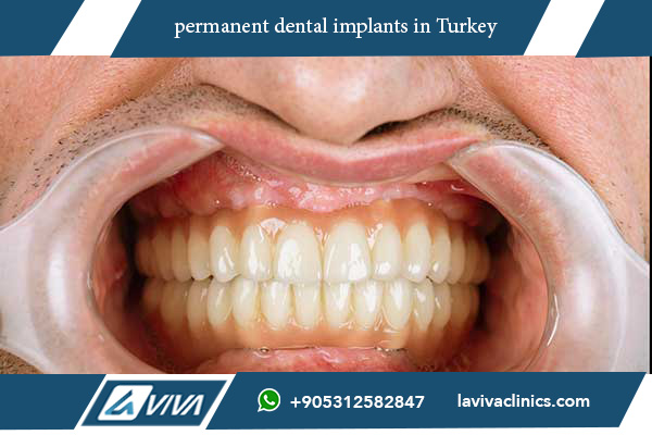 permanent dental implants