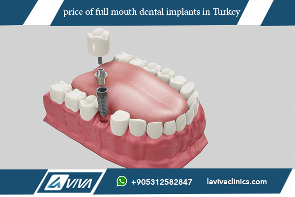 price of full mouth dental implants