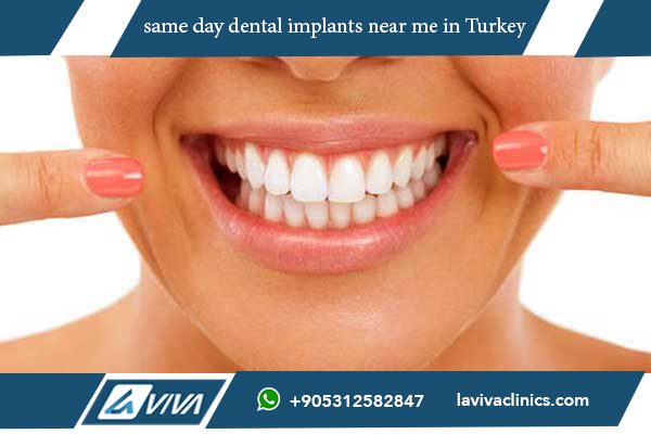 Same Day Dental Implants Near Me: The Ultimate Guide