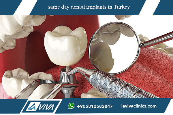 same day dental implants