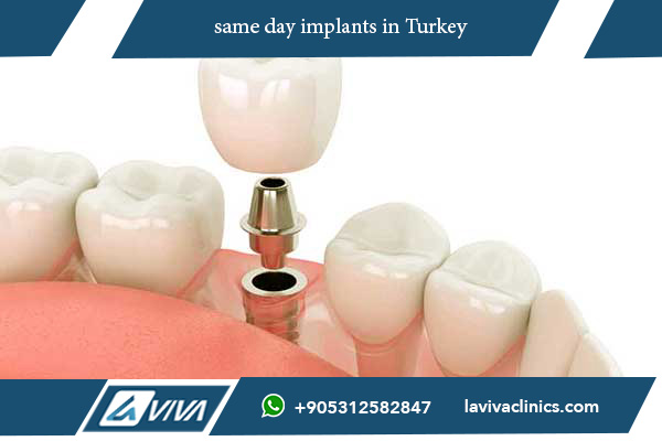 same day implants