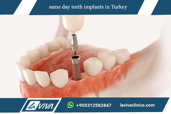 same day teeth implants