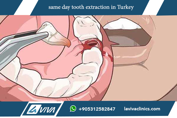 same day tooth extraction