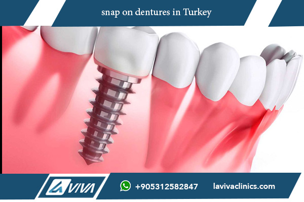 snap on dentures: A Comprehensive Guide to Improve Your Smile