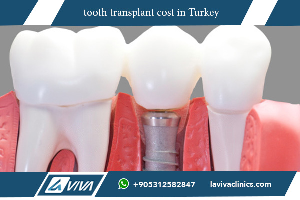 Comprehensive Guide to Tooth Transplant Cost: 10 Factors Affecting Your Decision