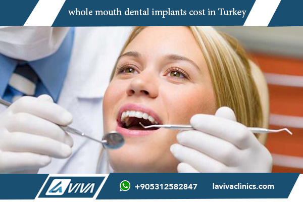 whole mouth dental implants cost