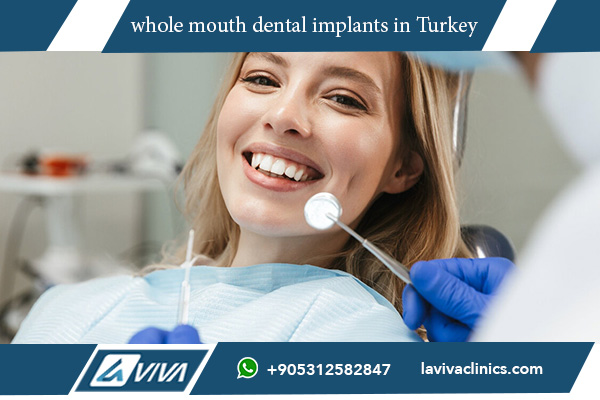 whole mouth dental implants