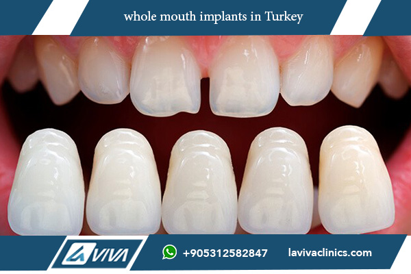 Whole Mouth Implants: The Complete Guide for a Positive Outcome