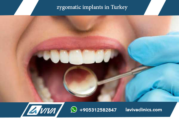 zygomatic implants