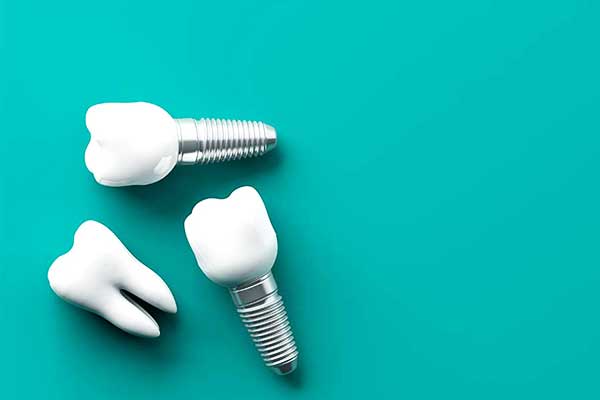 $1000 Dental Implants: Are They Worth the Risk or Reward?