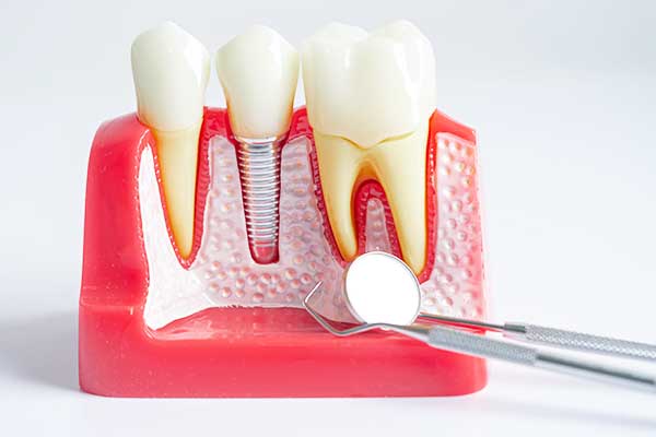 $1200 Dental Implants: Affordable Smile Restoration or Just a Myth?