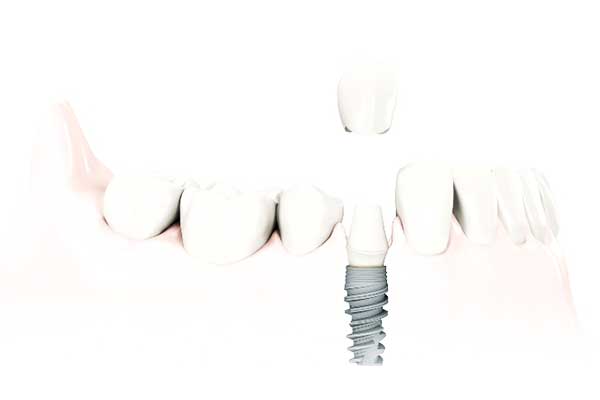 The Truth About “$399 Dental Implants” – What You Need to Know Before You Commit