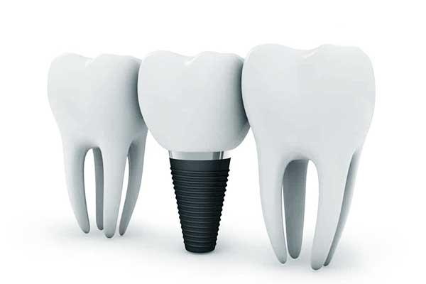 $800 Dental Implants: Can You Really Get Affordable Implants?