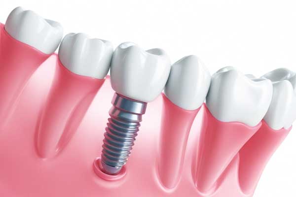 Unlocking Affordable Smiles: The Truth Behind $99 a Month Dental Implants