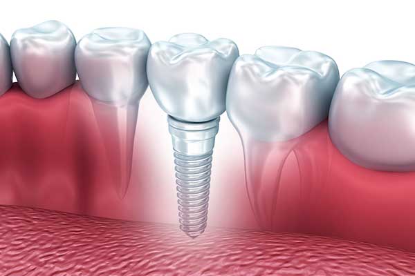 24 hour dental implants : A Complete Guide to Your New Smile in One Day