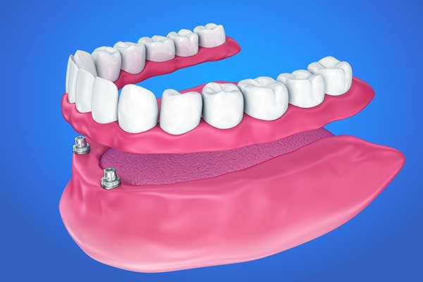 Everything You Need to Know About 3 on 6 Dental Implants: A Comprehensive Guide