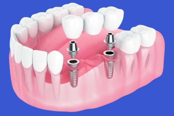 Discover the 3 on 6 dental implants cost : What You Need to Know Before Making Your Decision