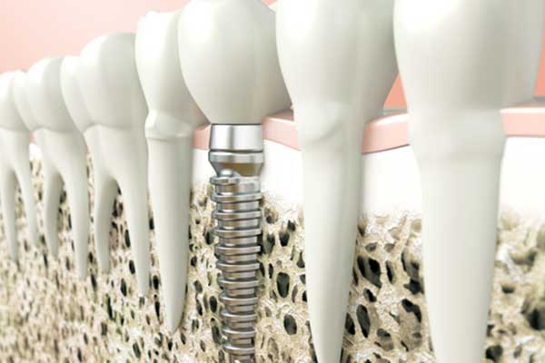 A Comprehensive Guide to 3i Dental Implants: Everything You Need to Know