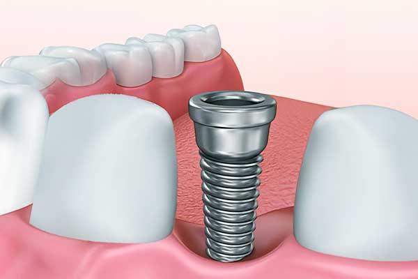 Discover the Magic of 4 in 1 Dental Implants: A Complete Guide