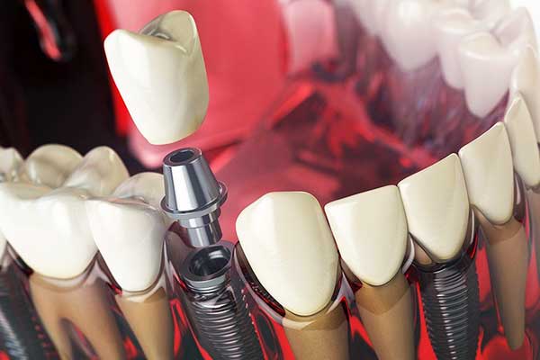 The True 4 in 1 dental implants cost : Everything You Need to Know