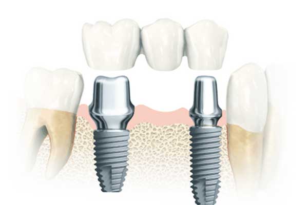 How Much Do 4 Dental Implants Cost? A Comprehensive Guide to the Procedure and Pricing