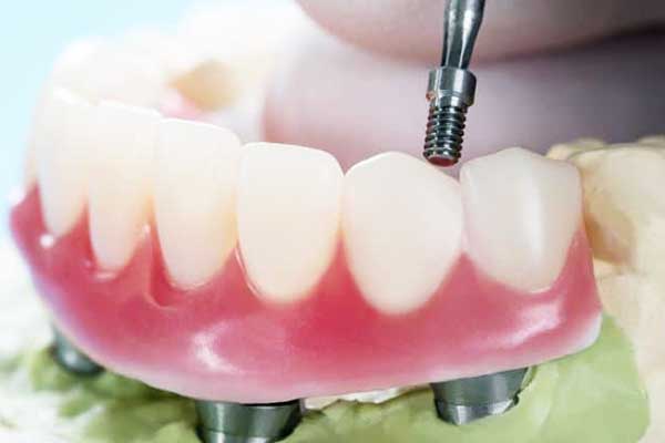 Discover the Benefits of 4 on 4 Dental Implants: A Comprehensive Guide