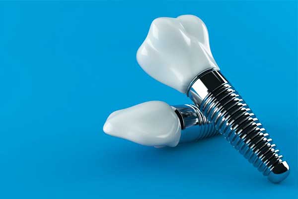 7 Essential Insights About AARP Dental Implants: Save Money and Protect Your Smile