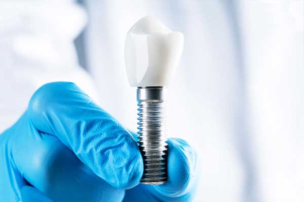 The Ultimate Guide to 4 on 4 Dental Implants Cost: What You Need to Know