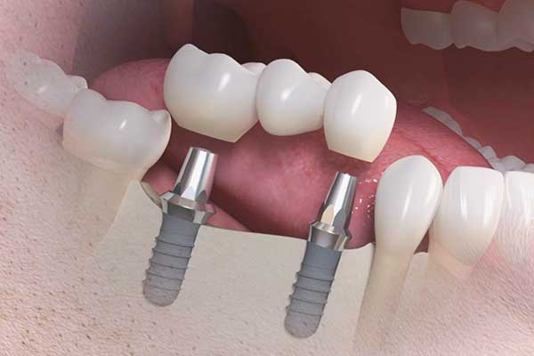 5 Ways Adin Dental Implants Lead Innovation in the Dental Implant Market