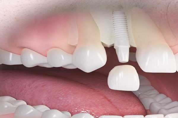 The Ultimate Guide to Advanced Dental Implants: Everything You Need to Know for a Perfect Smile