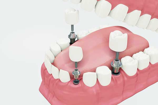 7 Essential Tips for Finding Affordable Dental Implants