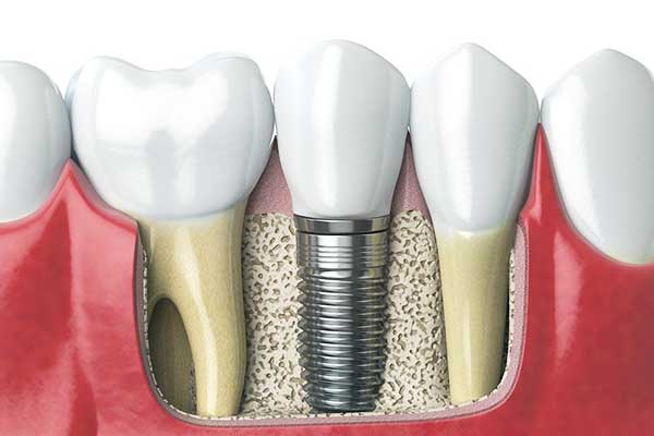 How to Save Big: Understanding Affordable Dental Implants Cost in 2024