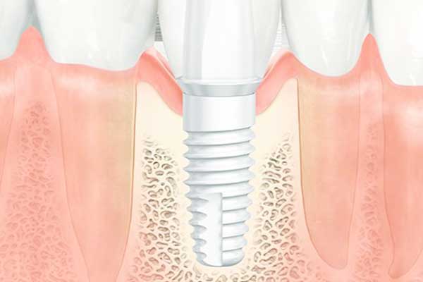 A Complete Guide to all on 2 dental implants: Affordable, Efficient, and Secure