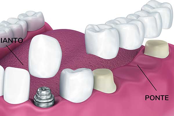 The Ultimate Guide to Preventing and Managing all on 4 dental implants breaking