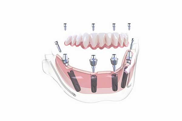 The True all on 4 dental implants cost: What You Need to Know