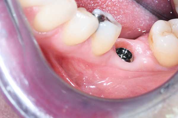 all on 4 dental implants cost 2021 : Everything You Need to Know