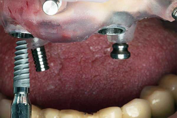 all on 4 dental implants cost 2022 : A Complete Guide to Smile Restoration