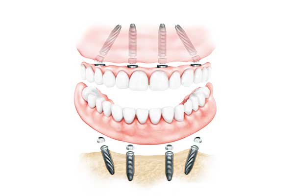 Unlocking the Secrets of all on 6 dental implants : A Complete Guide