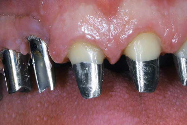 The Complete Guide to all on 6 dental implants cost in 2024