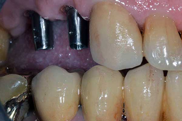 Discover all on 8 dental implants: The Best Full-Mouth Restoration Solution