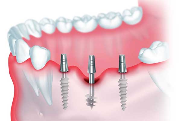 The Ultimate Guide to Astra Dental Implants: Why They’re a Game Changer for Your Smile